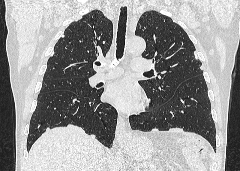 File:Asbestos pleural placques (Radiopaedia 57905-64872 Coronal lung window 149).jpg