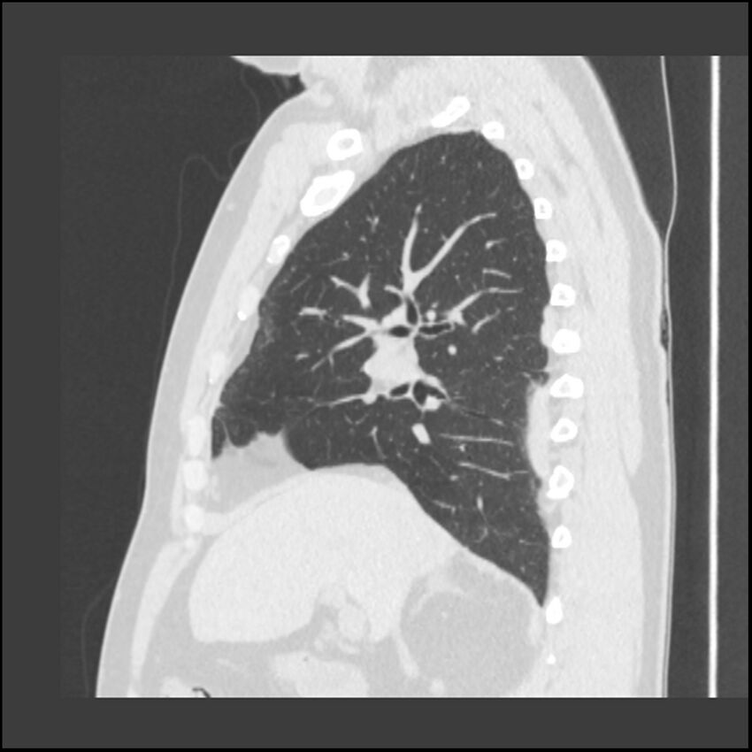 Asbestosis (Radiopaedia 45002-48961 Sagittal lung window 86).jpg