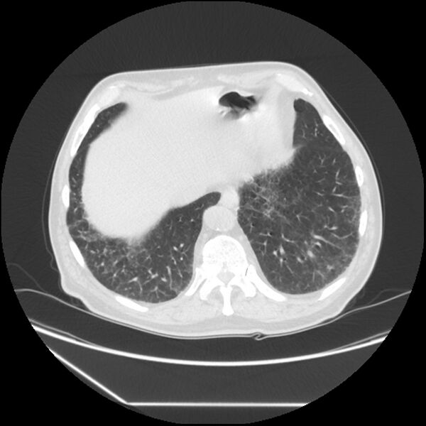 File:Asbestosis complicated by lung cancer (Radiopaedia 45834-50116 Axial lung window 56).jpg