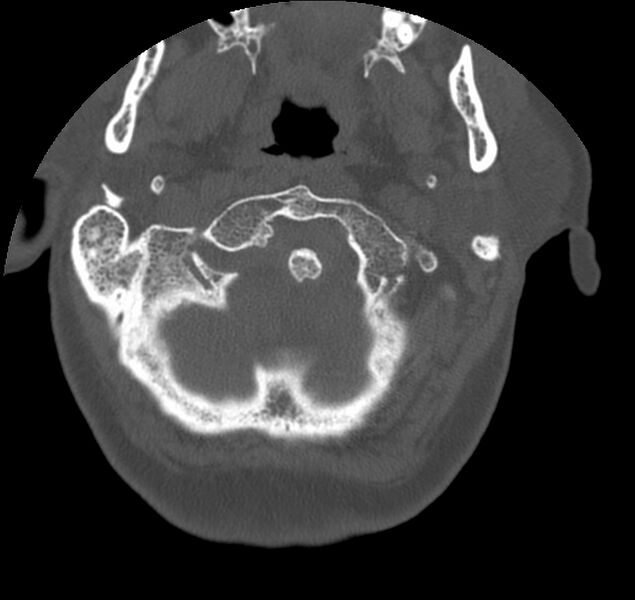 File:Atlanto-occipital assimilation with basilar invagination (Radiopaedia 70122-80188 Axial bone window 13).jpg