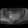 Atypical deep infiltrating endometriosis (Radiopaedia 44470-48125 Axial T1 fat sat 15).jpg