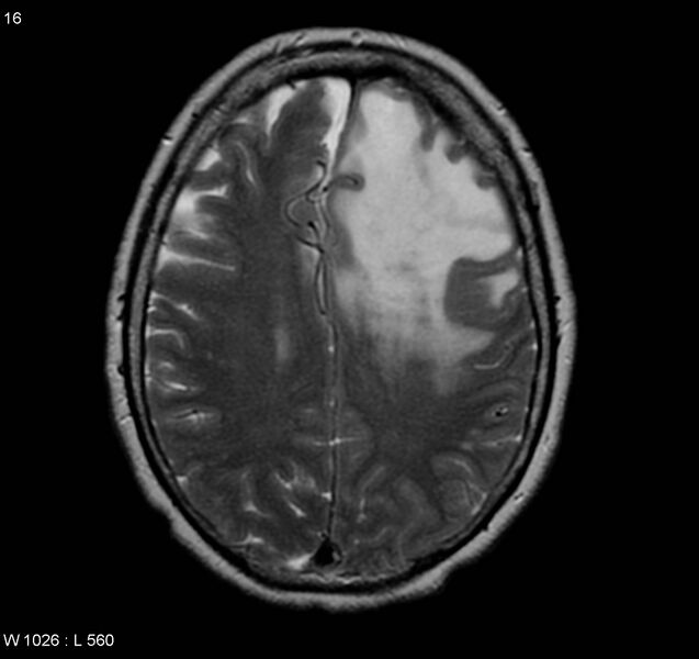 File:Atypical meningioma (WHO grade II) (Radiopaedia 5273-7016 Axial T2 9).jpg