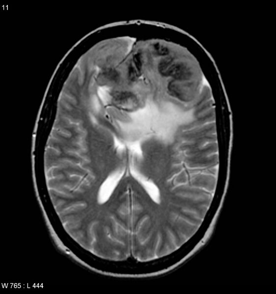 File:Atypical meningioma (WHO grade II) (Radiopaedia 7762-8586 Axial T2 3).jpg
