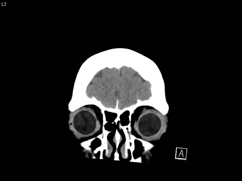 Atypical meningioma - intraosseous (Radiopaedia 64915-73867 B 12).jpg