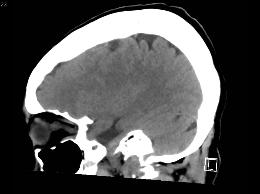 Atypical meningioma - intraosseous (Radiopaedia 64915-73867 C 21).jpg