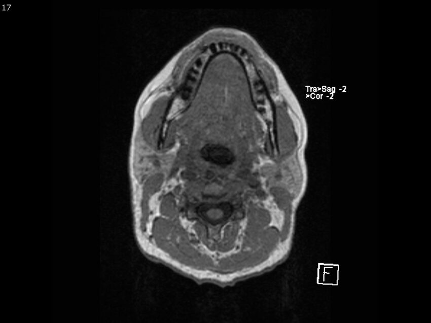 Atypical meningioma - intraosseous (Radiopaedia 64915-74572 Axial T1 17).jpg