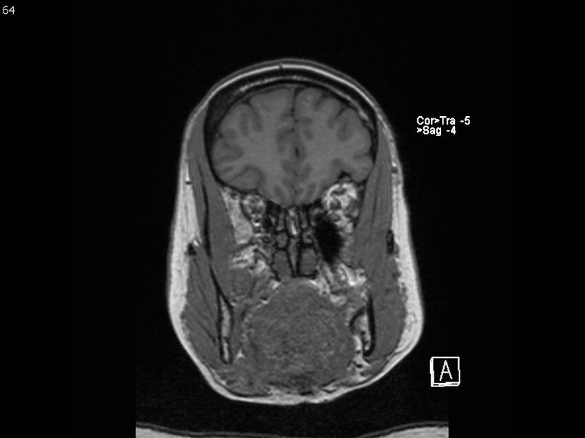 Atypical meningioma - intraosseous (Radiopaedia 64915-74572 Coronal T1 64).jpg