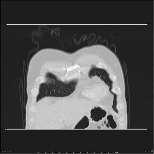 File:Atypical pneumonia - Q fever (Radiopaedia 21993-21989 C 3).jpg