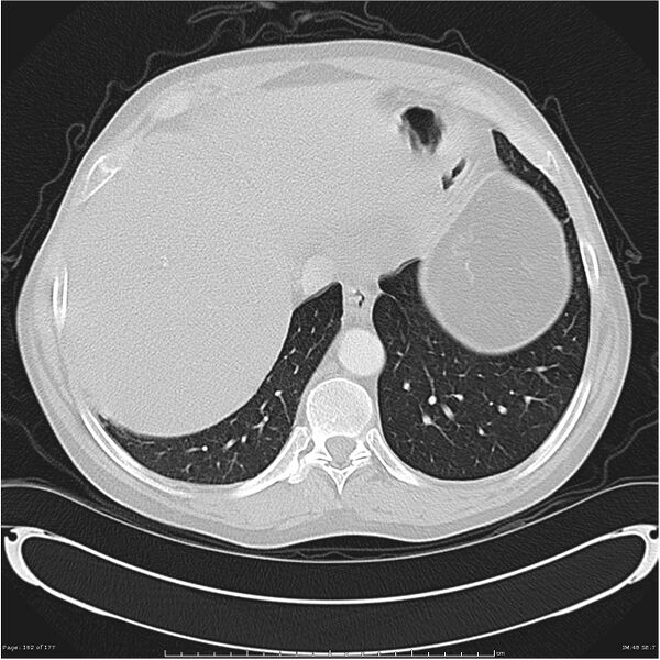 File:Atypical pneumonia - Q fever (Radiopaedia 21993-21989 lung window 41).jpg