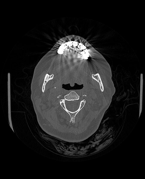 File:Automastoidectomy with labyrinthine fistula (Radiopaedia 84143-99411 Axial non-contrast 9).jpg