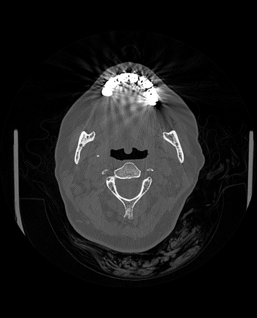 Automastoidectomy with labyrinthine fistula (Radiopaedia 84143-99411 Axial non-contrast 9).jpg