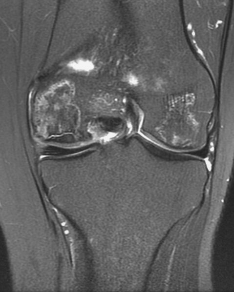 File:Avascular necrosis of the knee (Radiopaedia 2583-6277 Coronal STIR 1).jpg