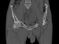 Avascular necrosis of the left hip (Radiopaedia 75068-86125 Coronal bone window 1).jpg