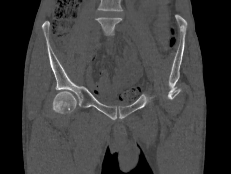 File:Avascular necrosis of the left hip (Radiopaedia 75068-86125 Coronal bone window 1).jpg