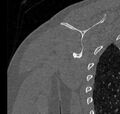 Avulsion fracture - greater tuberosity of humerus (Radiopaedia 71216-81514 Coronal bone window 57).jpg
