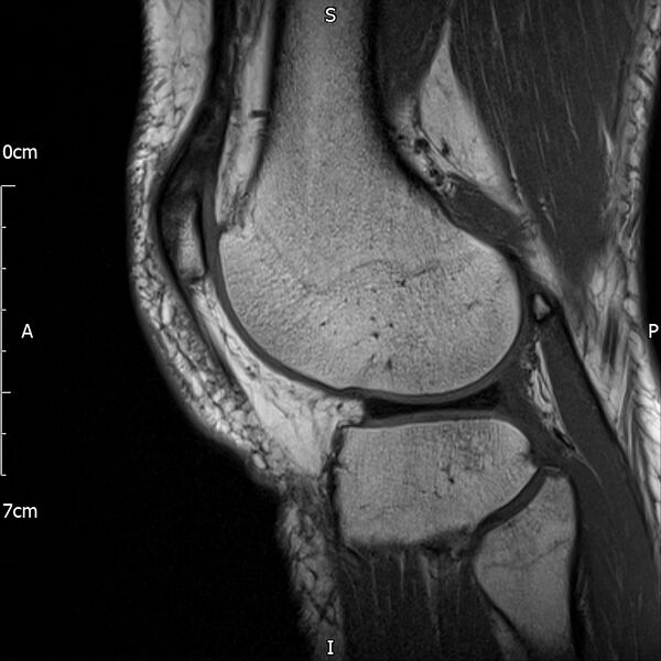 File:Avulsion fracture of the fibular head (Radiopaedia 74804-85808 D 26).jpg