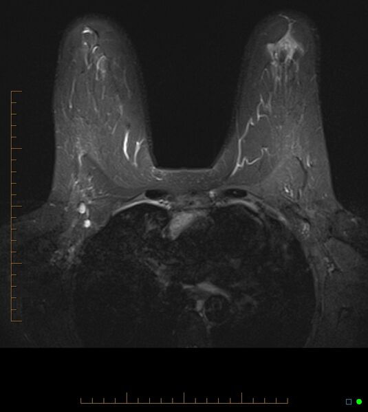 File:Axillary lymphadenopathy on breast MRI- yellow fever vaccination induced (Radiopaedia 19454-19483 Axial T2 fat sat 9).jpg