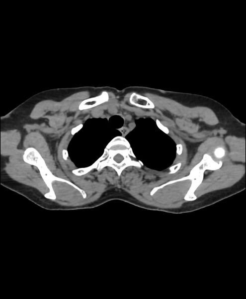 File:Azygos fissure and azygos lobe (Radiopaedia 41841-44832 Axial non-contrast 10).jpg