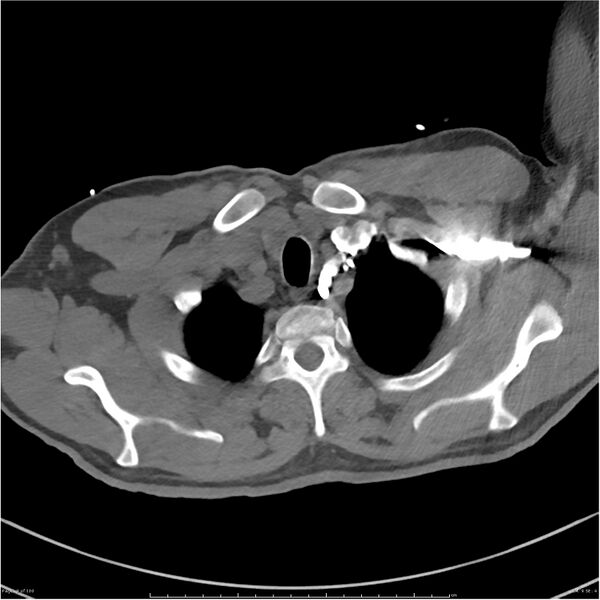 File:Azygos venous system anatomy (CT pulmonary angiography) (Radiopaedia 25928-26077 Axial C+ CTPA 9).jpg
