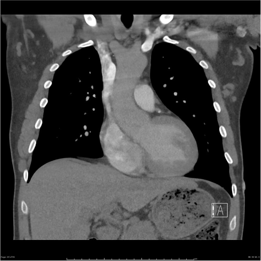 Azygos venous system anatomy (CT pulmonary angiography) (Radiopaedia 25928-26077 Coronal C+ CTPA 29).jpg