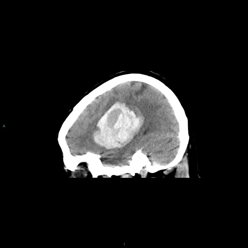 Basal ganglia hemorrhage (Radiopaedia 58349-65472 C 38).jpg