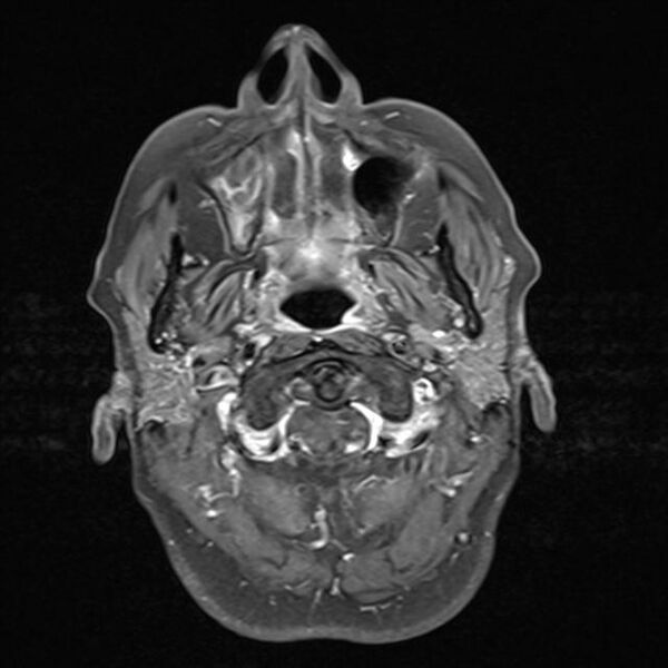 File:Base of skull chondrosarcoma (Radiopaedia 30410-31070 Axial T1 C+ fat sat 1).jpg