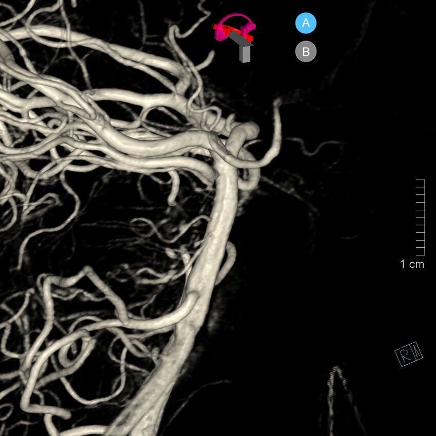 Basilar artery perforator aneurysm (Radiopaedia 82455-97734 3D view left VA 59).jpg