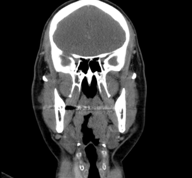 File:Benign mixed salivary tumor of the parotid gland (Radiopaedia 35261-36792 B 11).jpg
