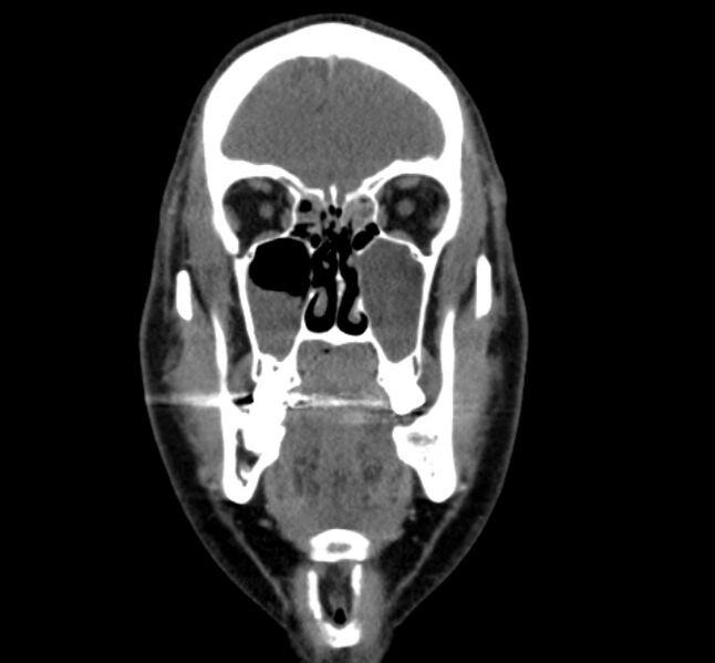 File:Benign mixed salivary tumor of the parotid gland (Radiopaedia 35261-36792 B 6).jpg