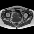 Bicornuate uterus (Radiopaedia 61974-70046 Axial T1 34).jpg