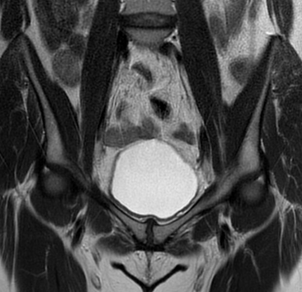 File:Bicornuate uterus (Radiopaedia 76407-88114 Coronal T2 5).jpg