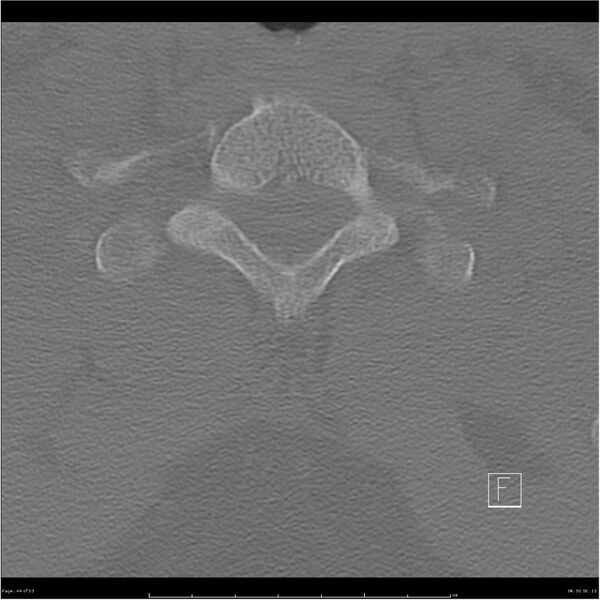 File:Bilateral cervical ribs (Radiopaedia 25868-26017 Axial bone window 44).jpg