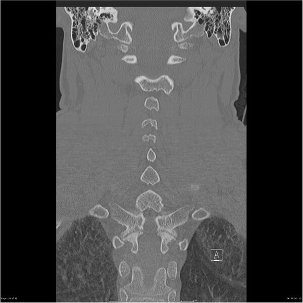 File:Bilateral cervical ribs (Radiopaedia 25868-26017 Coronal bone window 33).jpg