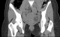 Bilateral mature cystic ovarian teratoma (Radiopaedia 88821-105592 Coronal non-contrast 13).jpg