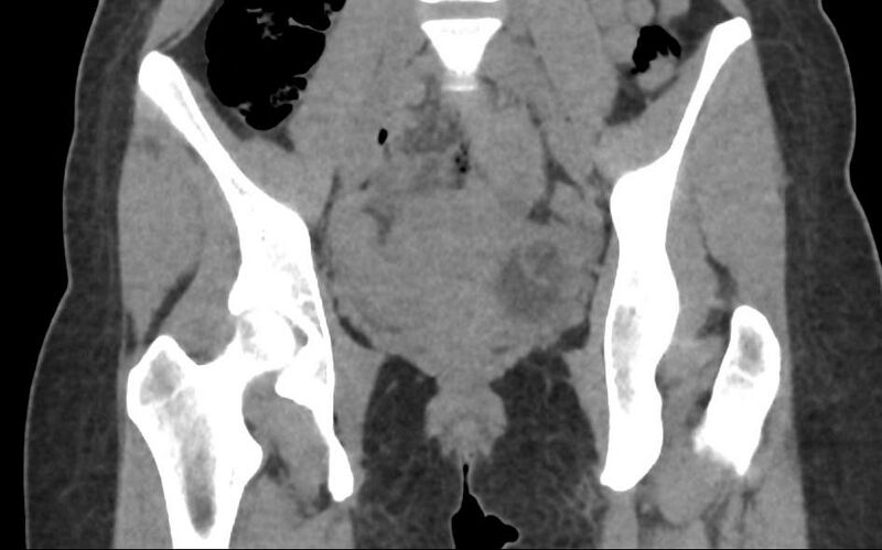 File:Bilateral mature cystic ovarian teratoma (Radiopaedia 88821-105592 Coronal non-contrast 13).jpg