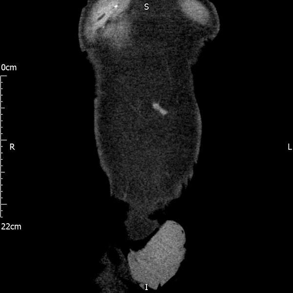 File:Bilateral medullary nephrocalcinosis with ureteric calculi (Radiopaedia 71269-81569 Coronal non-contrast 6).jpg