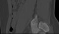 Bilateral pars defect (Radiopaedia 26691-26846 Sagittal bone window 53).jpg
