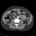 Biliary necrosis - liver transplant (Radiopaedia 21876-21845 A 35).jpg