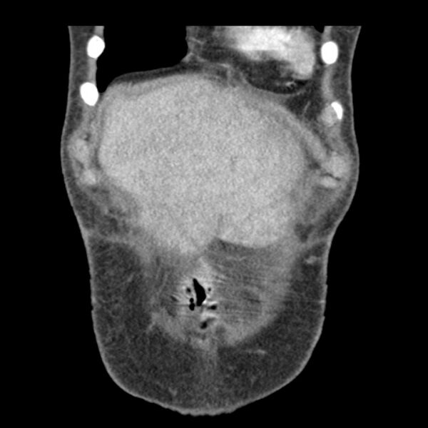 File:Biliary necrosis - liver transplant (Radiopaedia 21876-21846 C 3).jpg