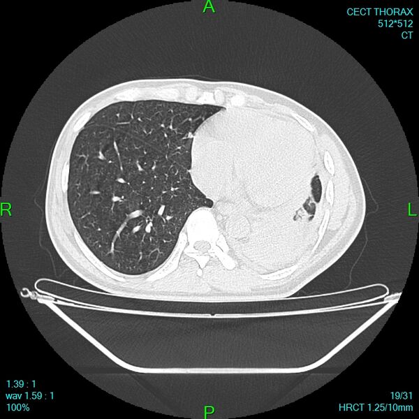 File:Bone metastases from lung carcinoma (Radiopaedia 54703-60937 Axial lung window 19).jpg