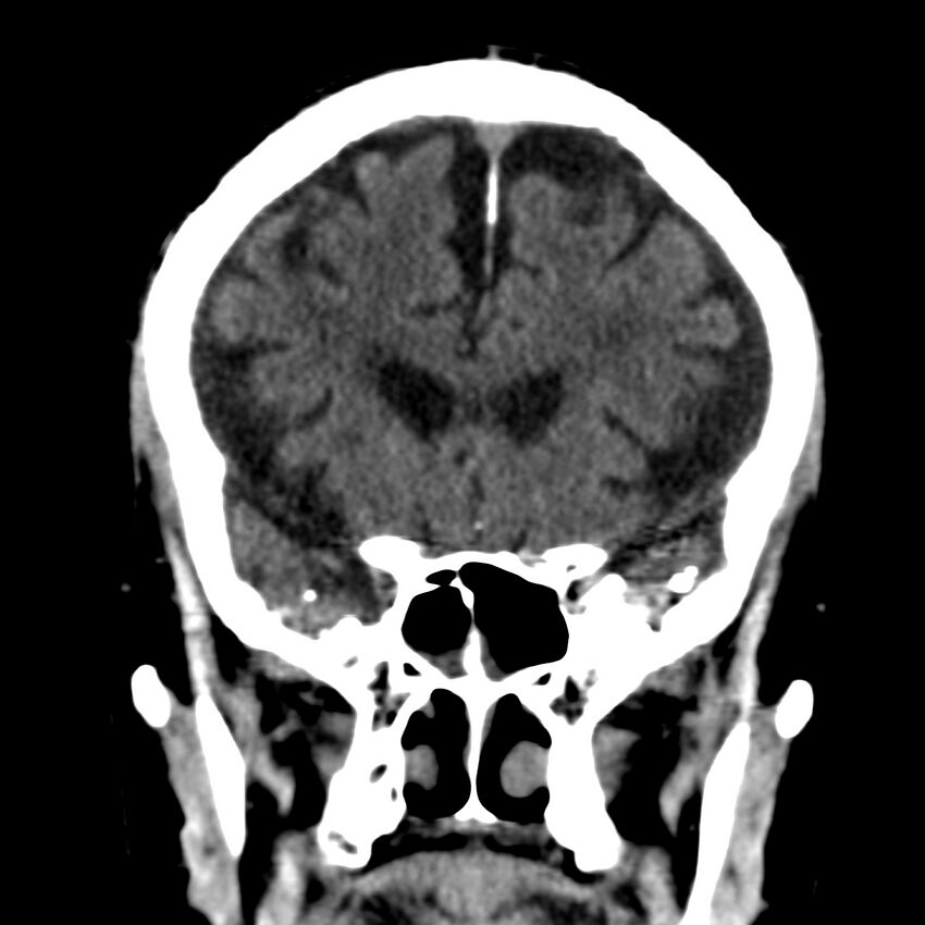 Brain Pantopaque remnants (Radiopaedia 78403-91048 Coronal non-contrast 25).jpg