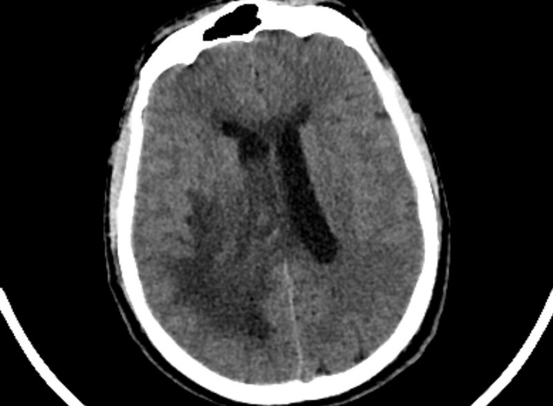 File:Brain abscess complicated by intraventricular rupture and ventriculitis (Radiopaedia 82434-96575 Axial non-contrast 61).jpg