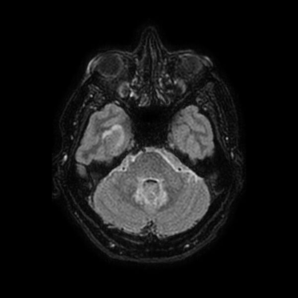 File:Brain abscess complicated by intraventricular rupture and ventriculitis (Radiopaedia 82434-96577 Axial FLAIR 15).jpg