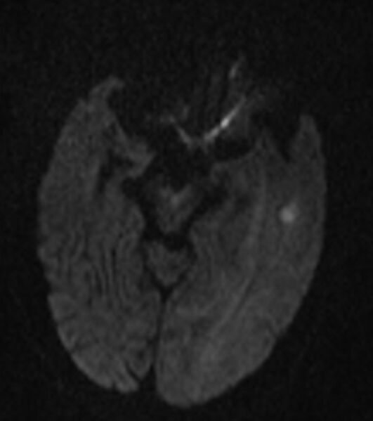 File:Brain abscess with dual rim sign (Radiopaedia 87566-103938 Axial DWI 7).jpg