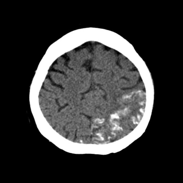 File:Brain cortical laminar necrosis (Radiopaedia 25822-25971 Axial non-contrast 35).jpg