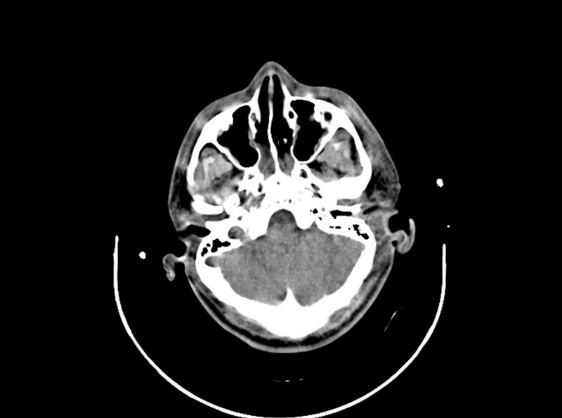 File:Brain injury by firearm projectile (Radiopaedia 82068-96087 B 57).jpg