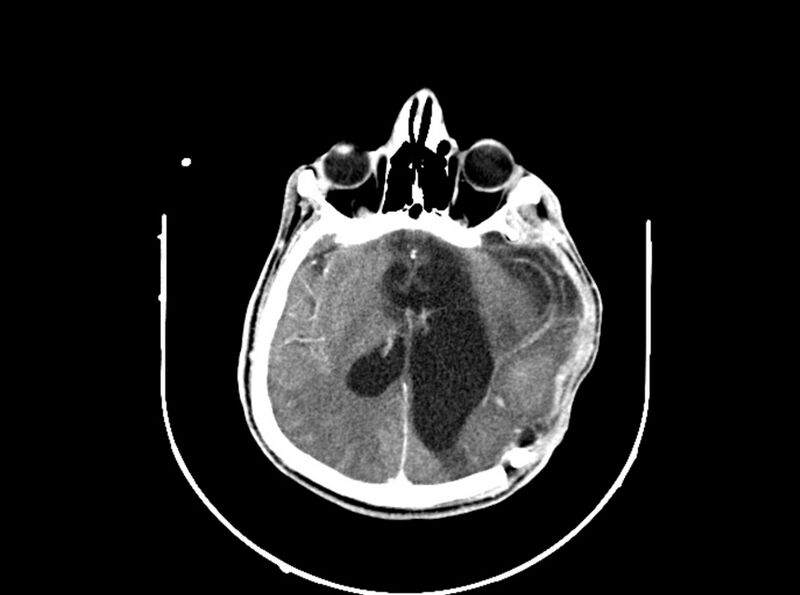 File:Brain injury by firearm projectile (Radiopaedia 82068-96088 B 131).jpg