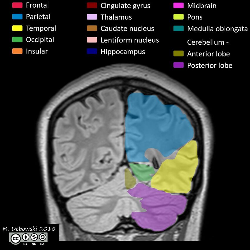 Brain lobes - annotated MRI (Radiopaedia 61691-69700 Coronal 55).JPG