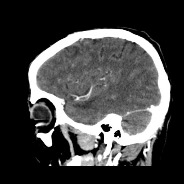 File:Brain metastases from lung cancer (Radiopaedia 24480-24781 C+ delayed 44).jpg