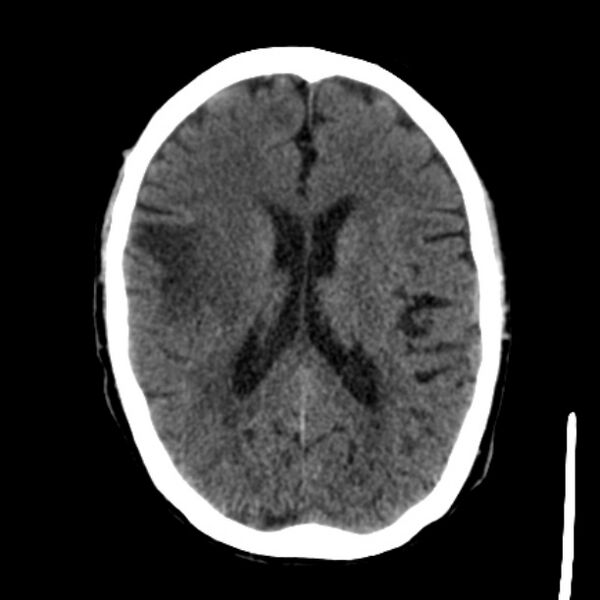 File:Brain metastases from lung cancer (Radiopaedia 27849-28092 Axial non-contrast 27).jpg